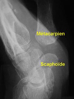 Pour éviter un recul du pouce, il est classique de remplacer le trapèze par un morceau de tendon "roulé en boule". Notez comme le métacarpien parait "flotter" au dessus du scaphoïde.