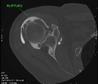 1/RUPTURE DE COIFFE :les trois plans de l'arthroscanner axial