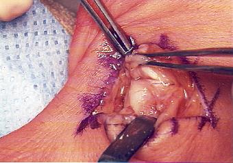 le Ligament desinséré est tenu par la pince